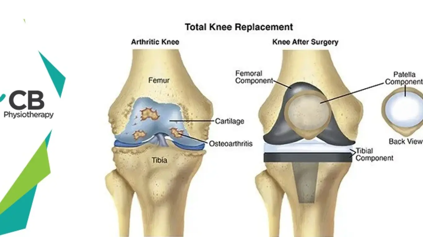 12 Best Postoperative Exercises For Knee Replacement