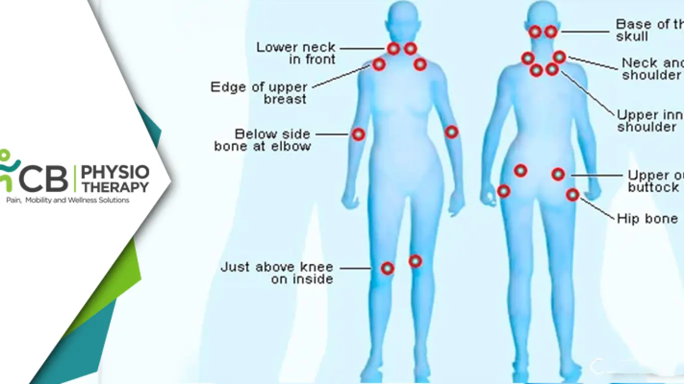 Fibromyalgia: Management Of Chronic Pain And Fatigue By Physiotherapy