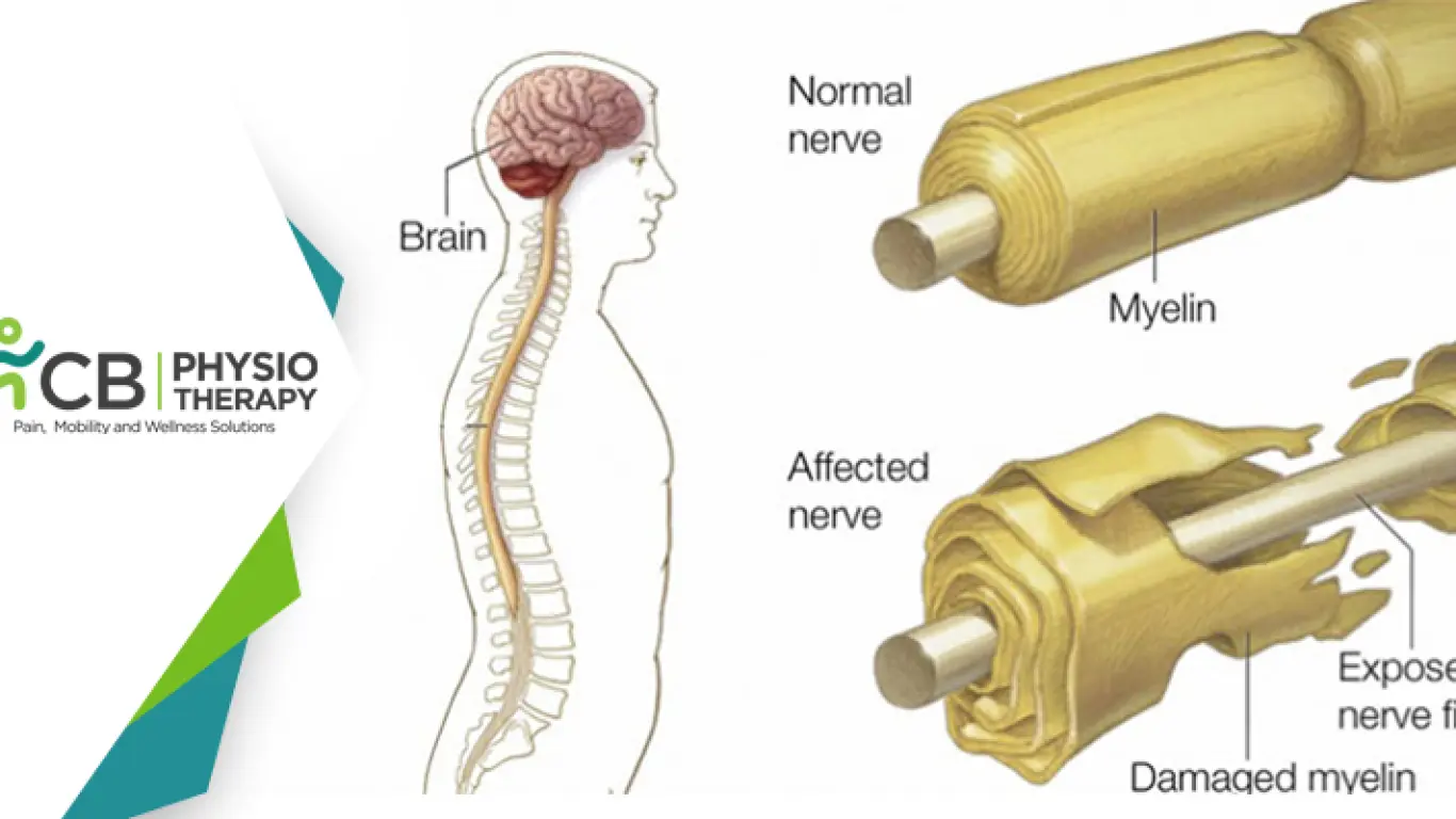 Guillain-barré Syndrome | Restoring Muscle Strength And Joint Functions By Physiotherapy