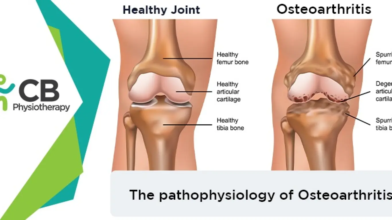 How Osteoarthritis Affects Our Body? Its Pathophysiology