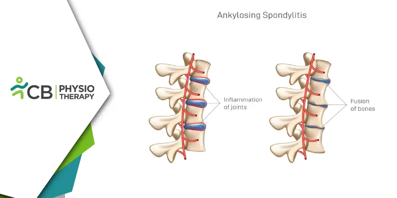 Ankylosing Spondylitis | How Physiotherapy Relieves Pain And Enhances Mobility?