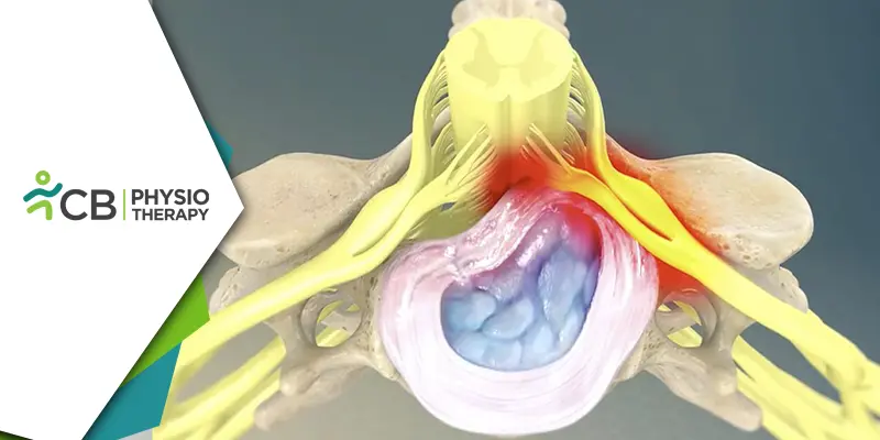 Cervical Myelopathy | How Physiotherapy Helps In Regaining Function And Control?