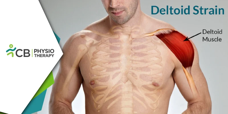 Deltoid Strain | Understanding Causes, Symptoms, And The Role Of Physiotherapy In Recovery