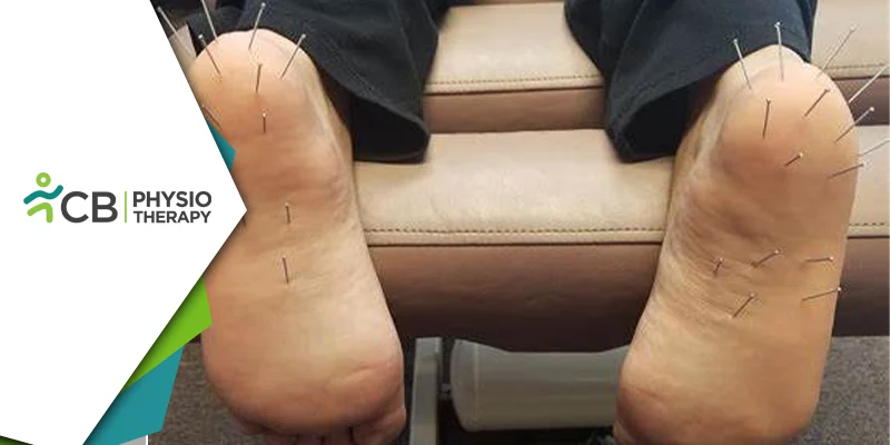 Dry Needling For Plantar Fasciitis | How It Can Help In The Management Of Heel Pain?