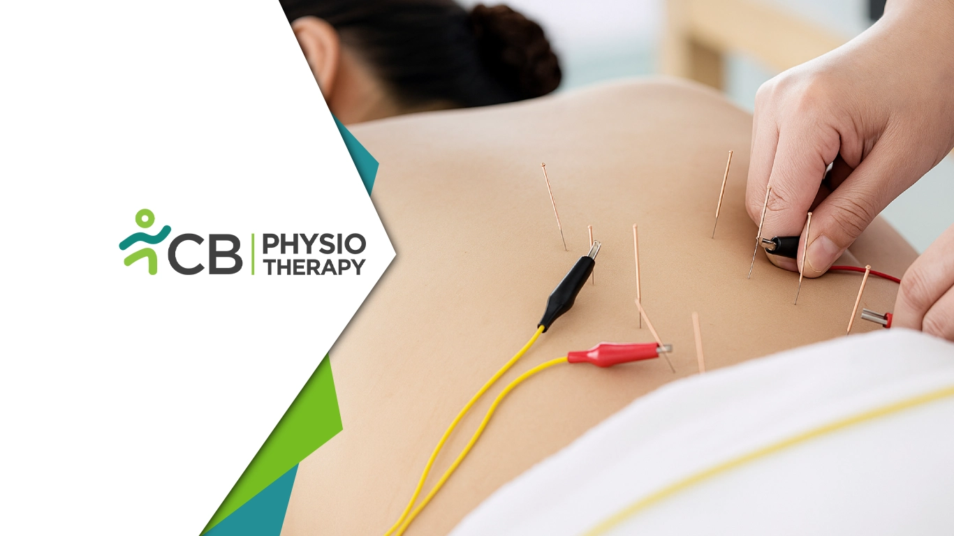 Electrical Dry Needling: Treat Muscle Pain & Restore Mobility — Cb Physiotherapy