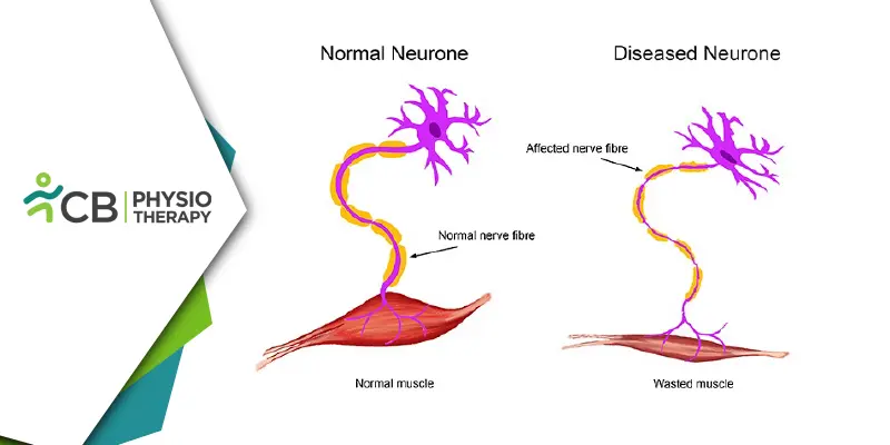Empowering Lives | The Crucial Role Of Physiotherapy In Managing Motor Neuron Disease (mnd)