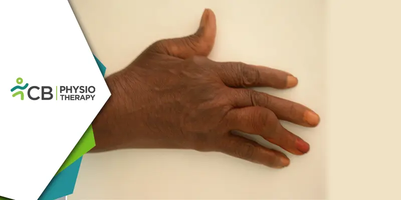 Exploring Rheumatoid Arthritis Deformities | Impact And Benefits Of Physiotherapy Treatment