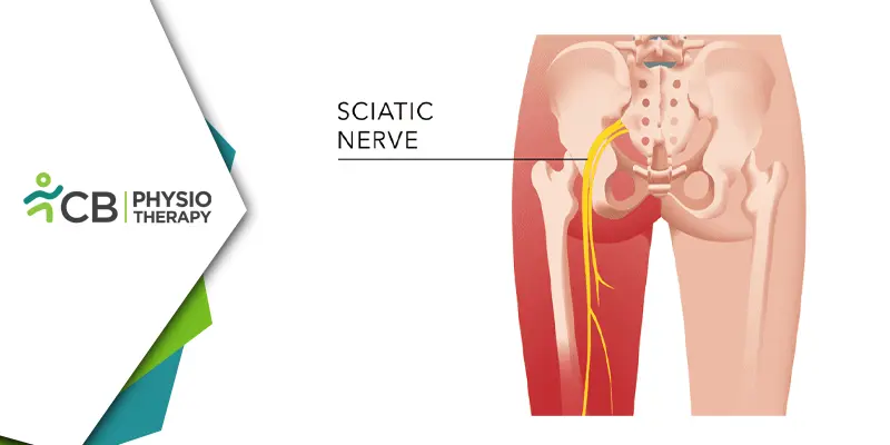Find Relief From Sciatica In South Delhi | Experience Healing With Physiotherapy At Cb Physiotherapy