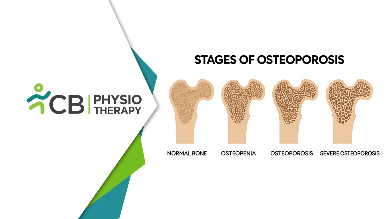 From Bone Loss To Bone Strength | Physiotherapy For Osteopenia, Osteoporosis & Arthrosis