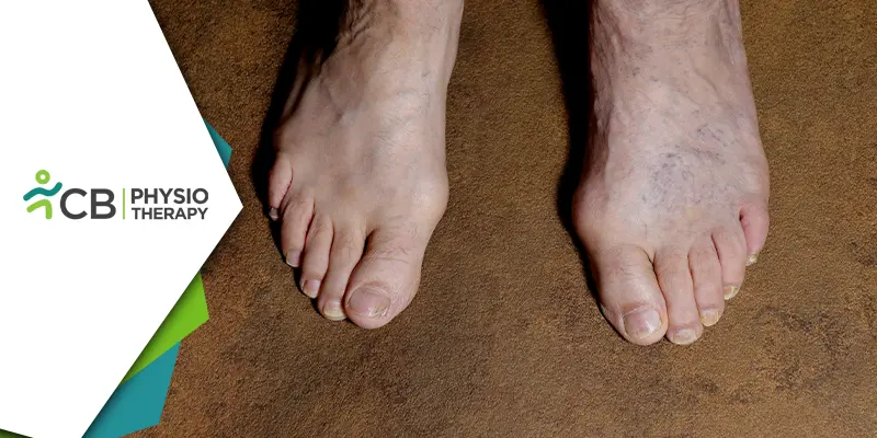 Gangrene Management | How Physiotherapy Plays A Vital Role In Recovery?