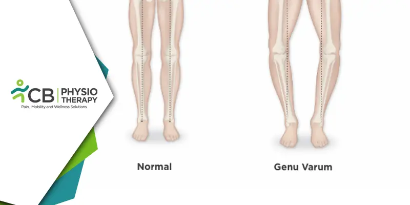 Genu Varum In Kids | A Physiotherapy Approach For Better Health.