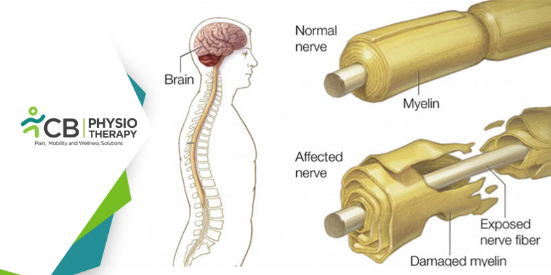 Guillain-barré Syndrome | Restoring Muscle Strength And Joint Functions By Physiotherapy