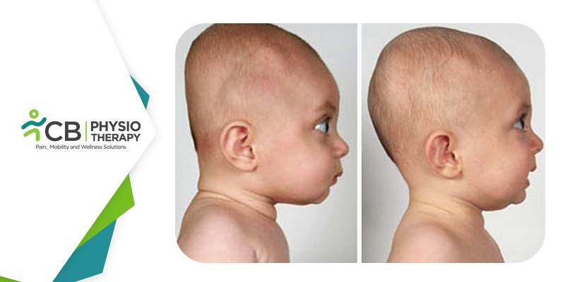 Infant Head Shape | How Physiotherapy Can Help Attain A Round Head?