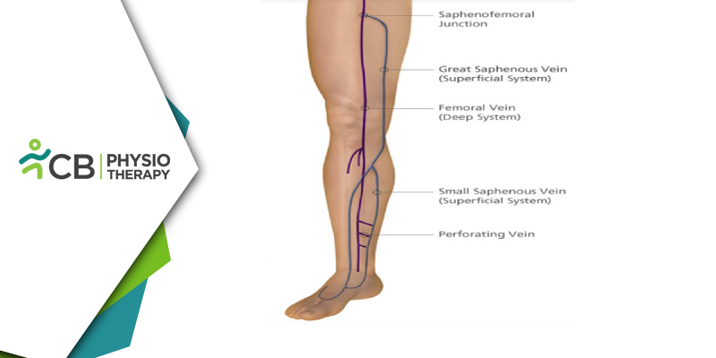 Intermittent Claudication | The Role Of Physiotherapy In Managing Peripheral Artery Disease