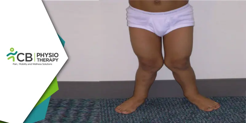 Managing Genu Valgus In Children | Strengthening And Stretching Of Stiff Muscles For Improved Growth