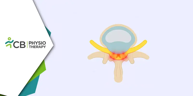Neurogenic Claudication | Role Of Physiotherapy In Easing Pain, Enhancing Mobility, And Elevating Quality Of Life