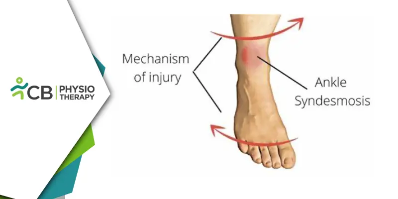 Preventing And Managing High Ankle Sprains | Essential Physiotherapy Tips And Strategies