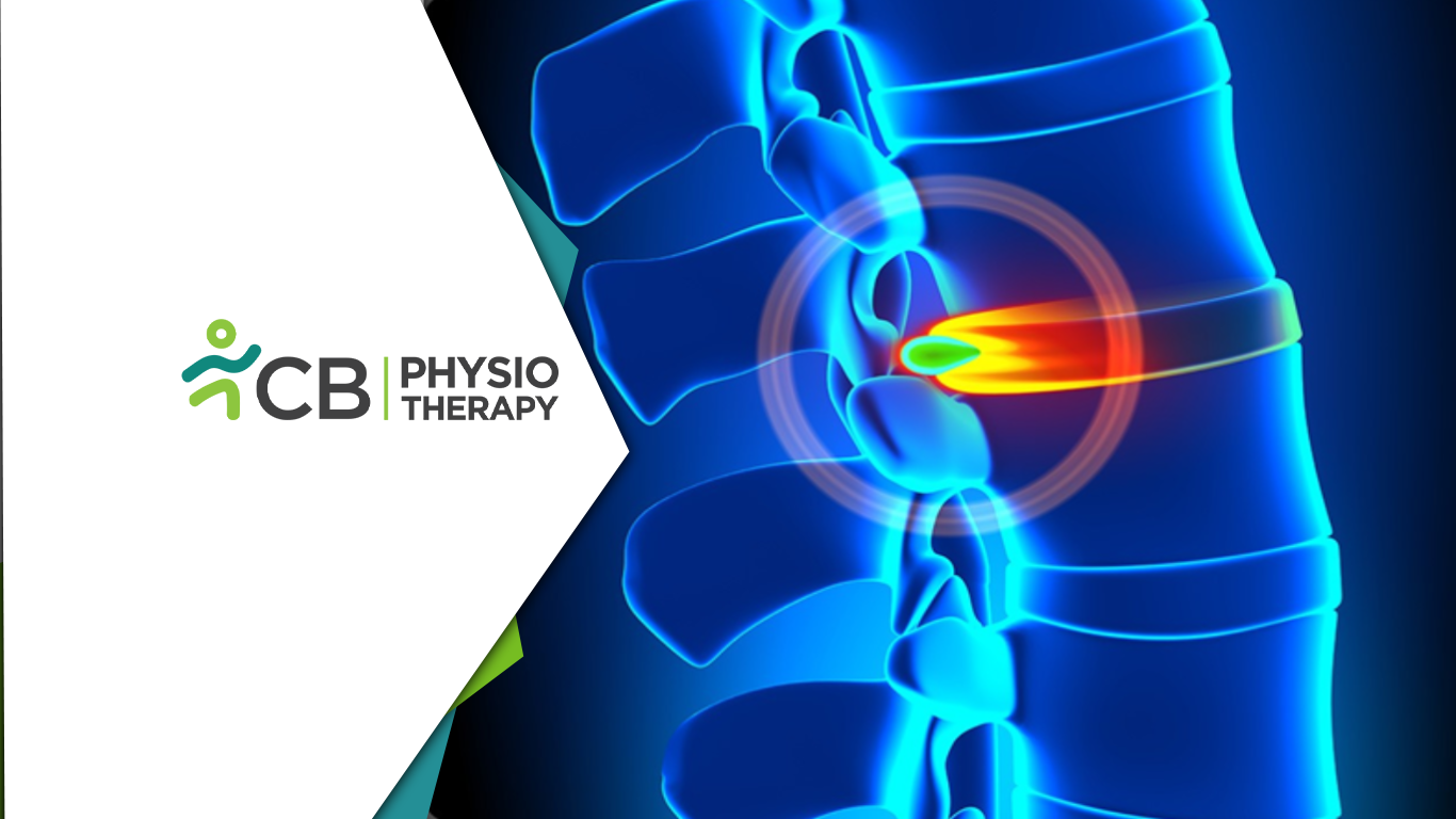 Protect Your Spine Before It Slips | How Physiotherapy Helps Prevent Disc Herniation?