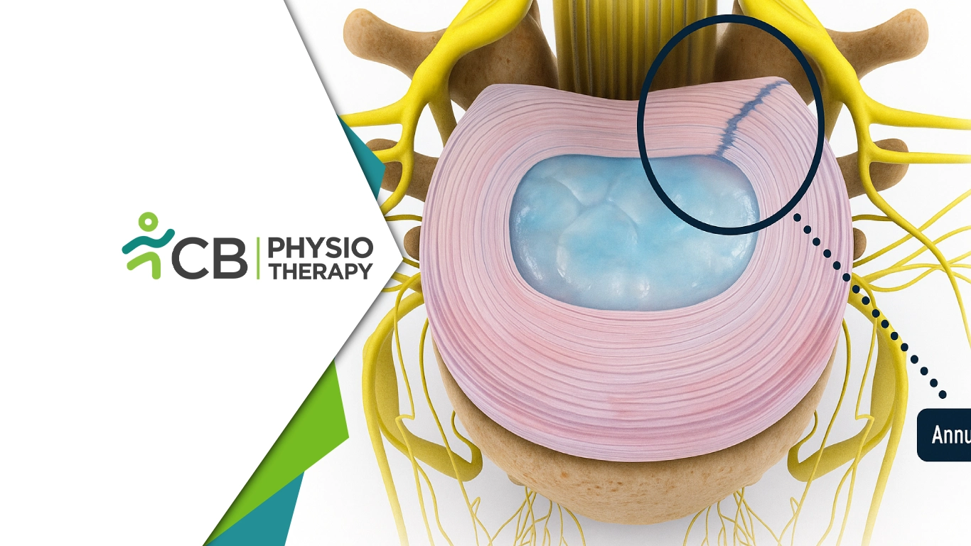 Recover From Back Pain | How To Heal An Annular Tear Without Surgery By Physiotherapy