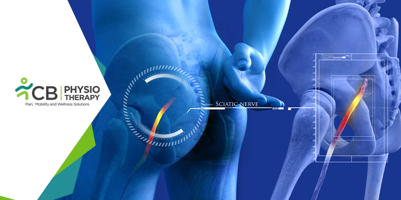Sciatica | How Physiotherapy Management Helps In Relieving The Sciatic Nerve Pain?
