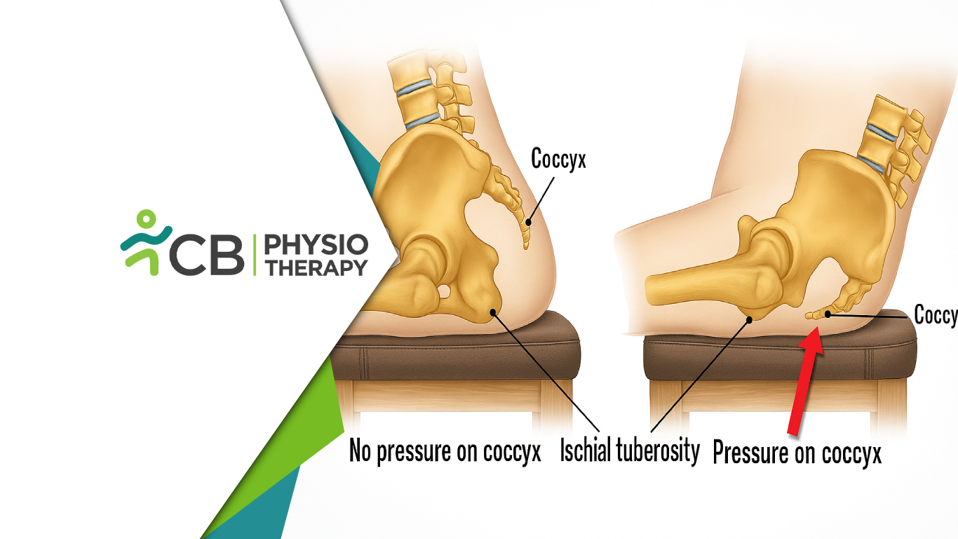 Tailbone Pain No More: Safe Approach For Treating Coccydynia At Cb Physiotherapy