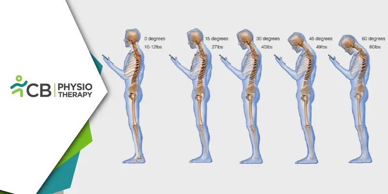 Text Neck Syndrome | How Physiotherapy Can Prevent And Treat This Modern-day Epidemic