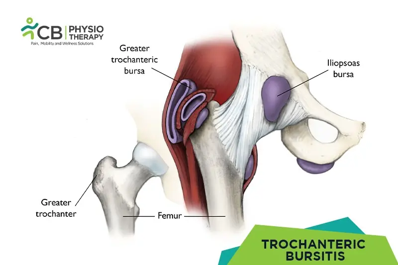 Trochanteric Bursitis