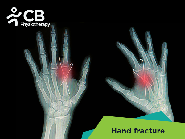 Hand Fractures