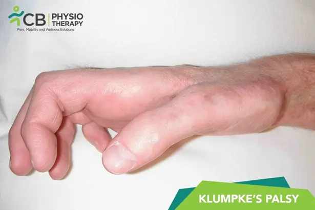 Klumpke's Palsy