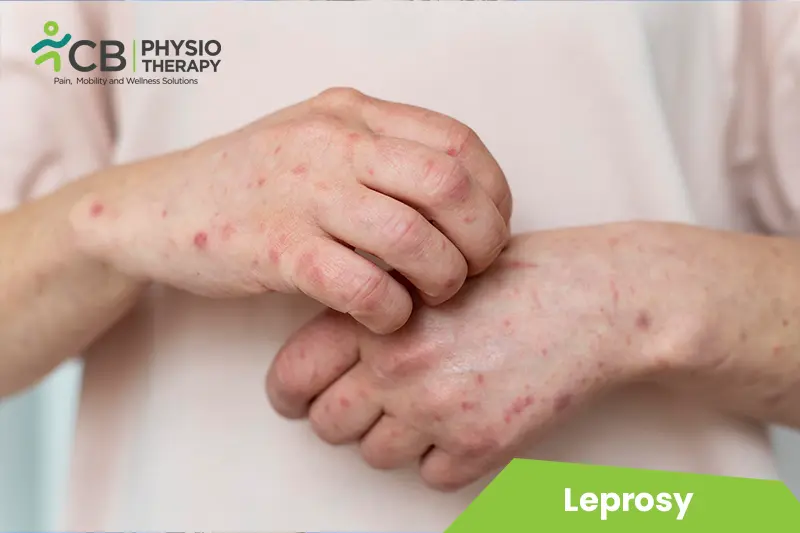 Leprosy