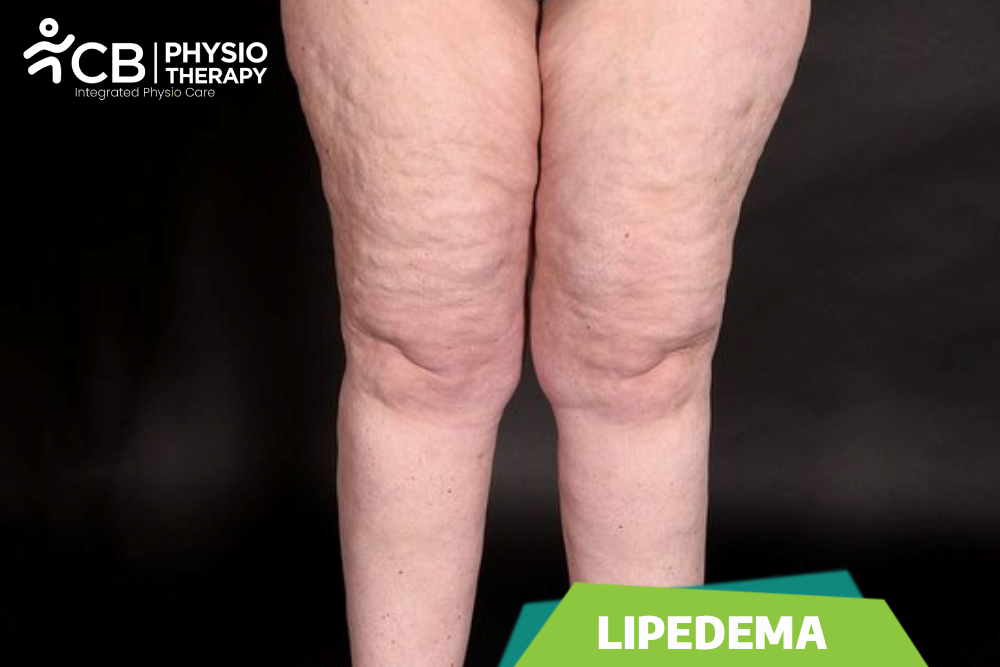 Lipedema