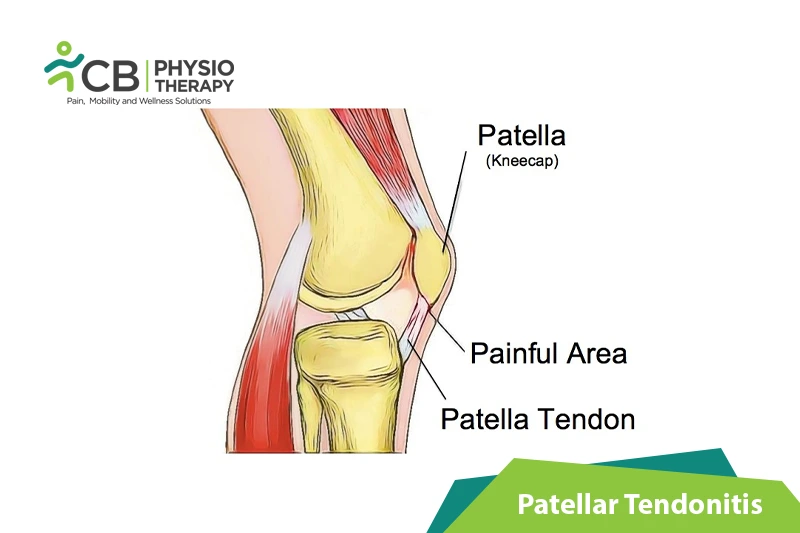 Patellar Tendonitis