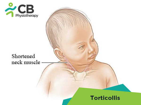Torticollis