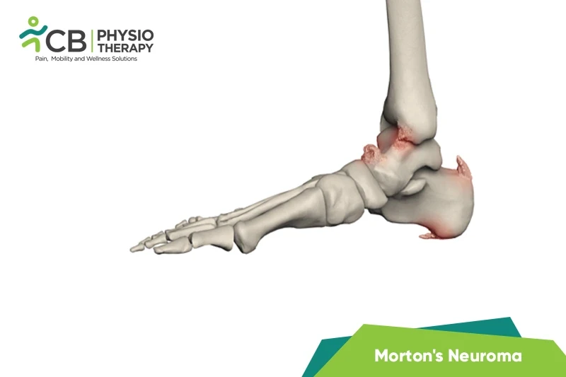 Top 5 Exercises For Ankle Bone Spur.