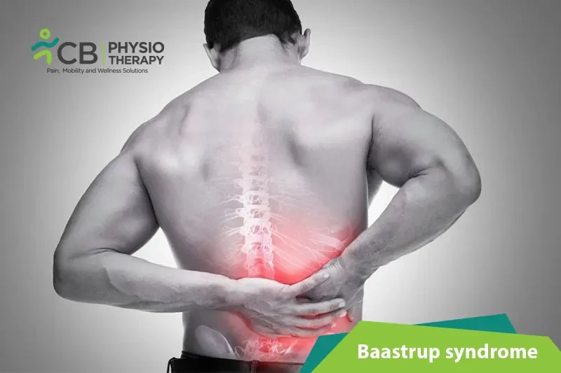 Top 5 Exercises For Baastrup Syndrome