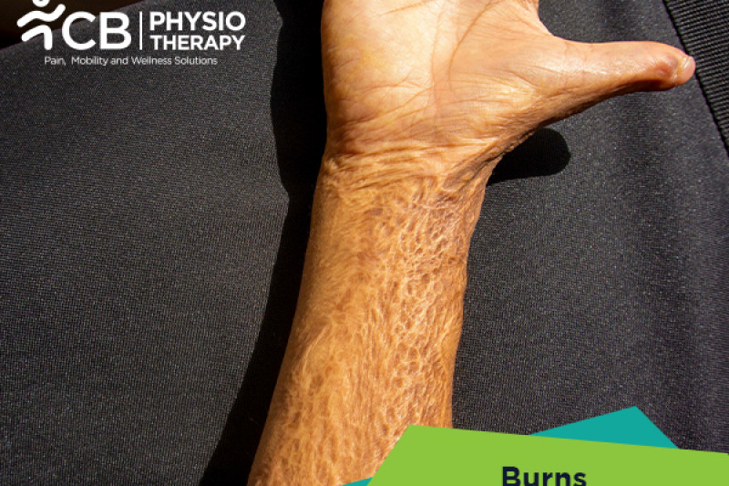 Top 5 Exercises For Burns