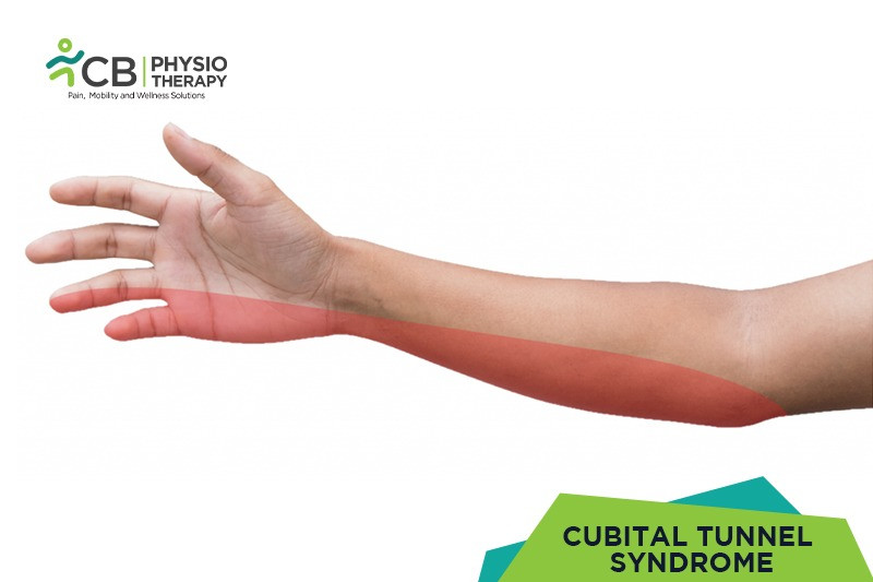 Top 5 Exercises For Cubital Tunnel Syndrome