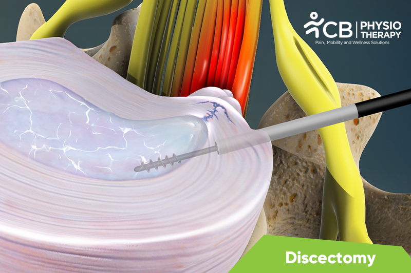 Top 5 Exercises For Discectomy