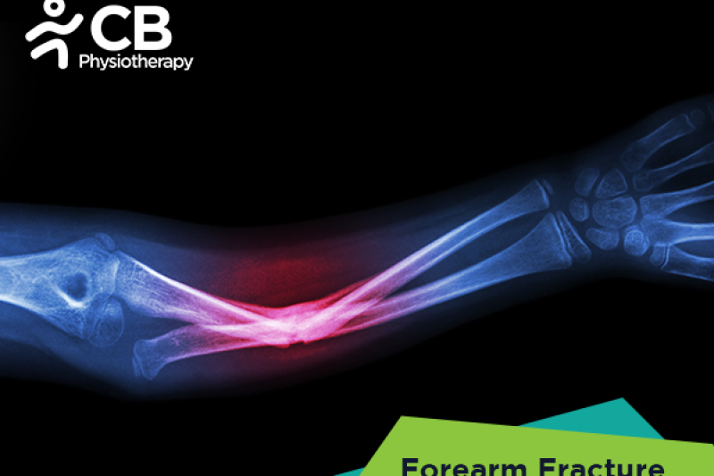 Top 5 Exercises For Forearm Fractures