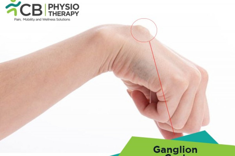 Top 5 Exercises For Ganglion Cyst (wrist)