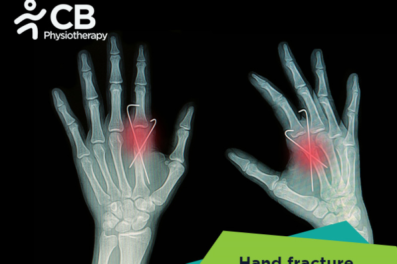 Top 5 Exercises For Hand Fractures