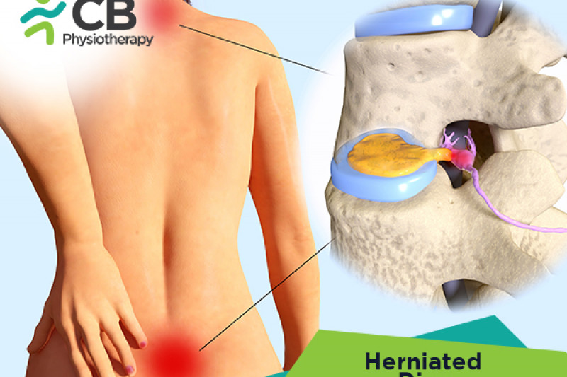 Top 5 Exercises For Herniated Disk Or Slipped Disc