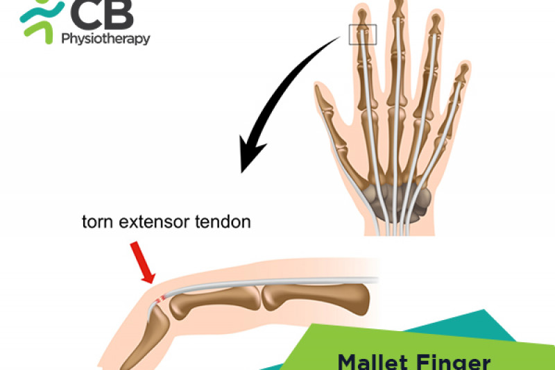 Top 5 Exercises For Mallet Finger