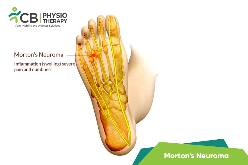 Top 5 Exercises For Morton's Neuroma