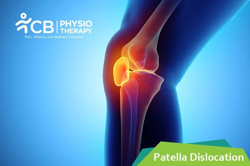 Top 5 Exercises For Patella Dislocation