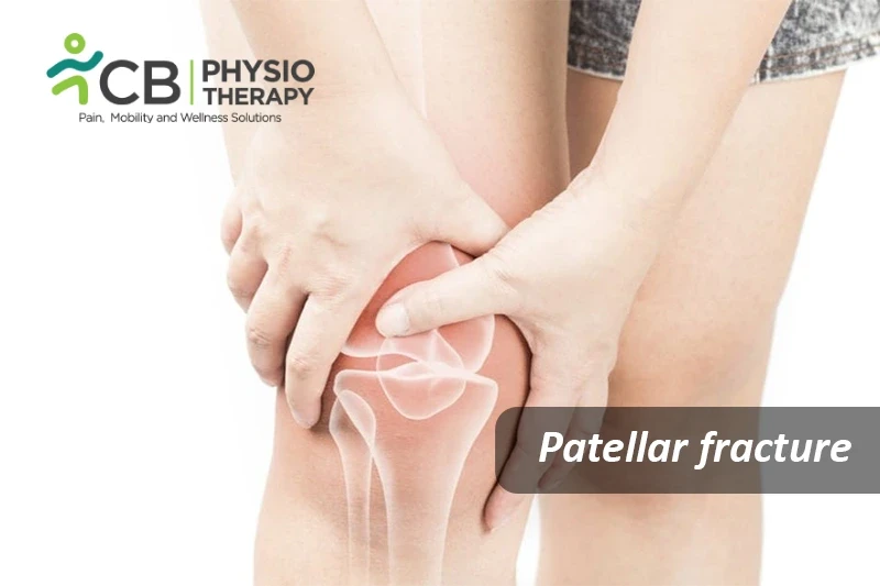 Top 5 Exercises For Patellar Fracture