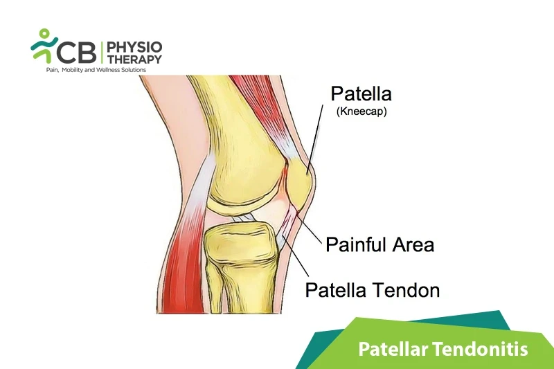 Top 5 Exercises For Patellar Tendonitis