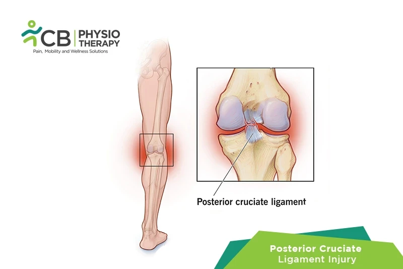 Top 5 Exercises For Posterior Cruciate Ligament Injury