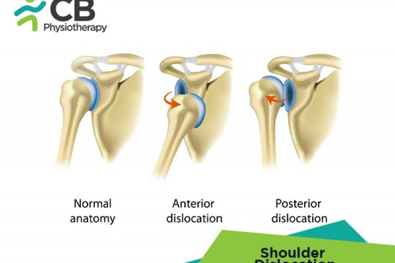 Top 5 Exercises For Shoulder Dislocation