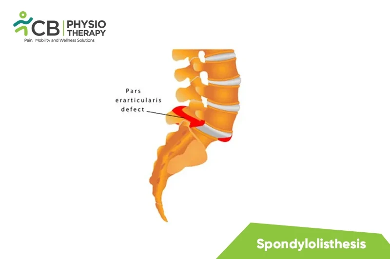Top 5 Exercises For Spondylolisthesis